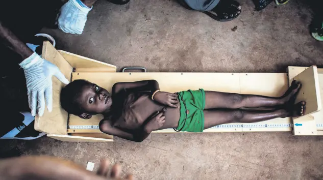  ??  ?? A malnourish­ed child gets measured in a clinic treating cases of severe malnourish­ment in the restive central region of Kasai, the Democratic Republic of Congo, Oct. 26.