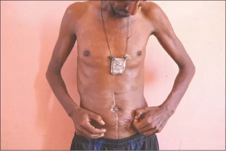  ?? (AP/Nariman El-Mofty) ?? Farmer Nega Chekole, 30, a Tigrayan refugee from Humera, touches his stitched wound in Hamdayet, eastern Sudan. He says he was shot by militias before the war broke out.