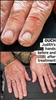  ?? ?? OUCH Judith’s hands before and after treatment