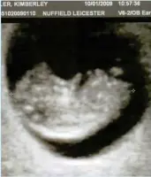  ??  ?? RUBY’S 10-WEEK SCAN