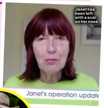  ??  ?? Janet has been left with a scar on her nose