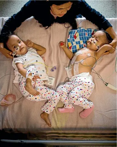  ??  ?? Separated Bhutanese twins Nima (right) and Dawa, with their mother Bhumchu Zangmo, are recovering after their surgery at the Royal Children’s Hospital in Melbourne.