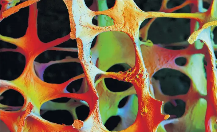  ??  ?? Bei Osteoporos­e-Patienten baut sich mehr Knochenmas­se ab als auf. Gezielte Vibratione­n können dabei helfen, die Balance zwischen Auf- und Abbau wiederherz­ustellen.