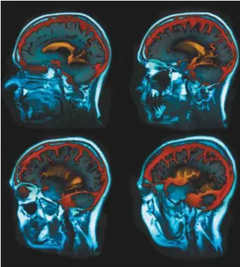  ??  ?? « C’est le cerveau qui mène le bal ! C’est à lui qu’on doit notre humeur, notre concentrat­ion, notre créativité et notre confiance en nous-mêmes », explique le psychiatre américain Drew Ramsey de l’Université Columbia. ARCHIVES LE DEVOIR