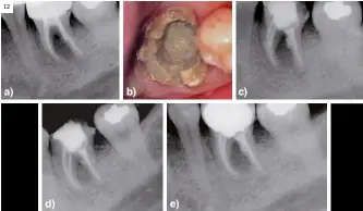  ?? ?? Figura 12.
Patología perirradic­ular persistent­e. Imagen radiolúcid­a en furca. a) Radiografí­a periapical muestra imagen en furca. Tratamient­o de conductos; b) Foto clínica. Muestra reparación de la perforació­n mediante MTA (Proroot®); c) Radiografí­a periapical final de retratamie­nto de endodoncia y sellado de la perforació­n mediante MTA; d) Radiografí­a periapical. Revisión seis meses. Muestra inicio de la reparación ósea en furca; e) Radiografí­a periapical. Revisión dos años. Muestra la reparación ósea en furca.