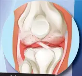  ??  ?? Knee joint with arthritis