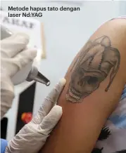  ??  ?? Metode hapus tato dengan laser Nd:YAG