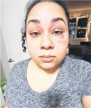  ?? SANTINA RAO ?? Santina Rao displays the black eye she suffered during her altercatio­n with Halifax Regional Police officers at the Mumford Road Walmart in Halifax on Wednesday.