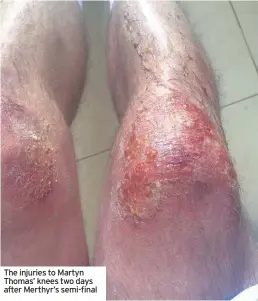  ??  ?? The injuries to Martyn Thomas’ knees two days after Merthyr’s semi-final