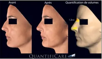  ?? (Photos N. C. et DR) ?? Une meilleure analyse de l’anatomie de la face permet de réaliser des dépôts plus harmonieux de produits, pour des résultats naturels autant au repos qu’en mouvement.