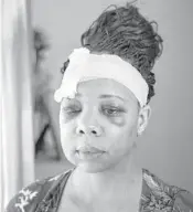  ?? AL DIAZ/MIAMI HERALD ?? LaToya Ratlieff talks about her experience days after police shot her in the face with a rubber bullet at an anti-police brutality protest May 31 in Fort Lauderdale.