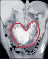  ??  ?? UNUSUAL: The five kidneys fused together