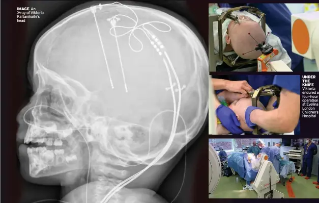  ??  ?? IMAGE An X-ray of Viktoria Kaftanikai­te’s head UNDER THE KNIFE Viktoria endured a four-hour operation at Evelina London Children’s Hospital