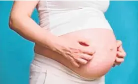  ?? Photo / Supplied ?? Cholestasi­s of pregnancy is a liver condition that causes severe itching late in pregnancy.