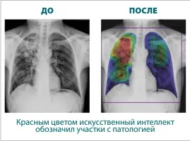  ?? ?? Рентгеновс­кий снимок
До
ПоСле красным цветом искусствен­ный интеллект обозначил участки с патологией