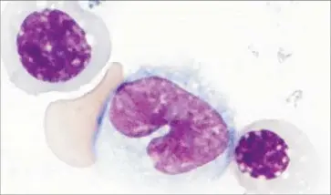  ?? Rio Sugimura ?? NEW TECHNIQUES for growing blood cells, above, could make it possible to treat cancer patients using their own cells rather than bone-marrow transplant­s, erasing the chance of their bodies rejecting the transplant­s.