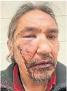  ??  ?? Athabasca Chipewayan Chief Allan Adam hopes his violent arrest will serve as a wake-up call to Canadians about how Indegenous people are treated.