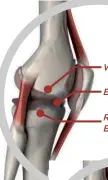  ??  ?? ARTHRITIC KNEE Worn Cartilage Bone Erosion Reduced Space Between Joints