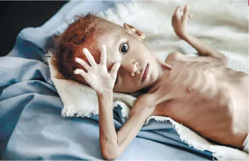  ?? AP FOTO ?? VULNERABLE. A severely malnourish­ed boy rests on a hospital bed at the Aslam Health Center in Hajjah, Yemen. A UN report says climate change and depletion of land and other resources is underminin­g food systems.