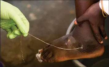  ?? OLIVIER ASSELIN / AP FILE (2007) ?? A guinea worm is extracted by a health worker from a child’s foot March 9, 2007, at a containmen­t center in Savelugu, Ghana.