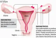  ?? ?? Trompa de Falopio
Ovario
ENDOMETRIO
Cérvix
FUENTE: Elaboració­n propia
ENDOMETRIO­SIS
LA VANGUARDIA