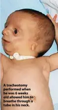  ??  ?? A tracheotom­y performed when he was 6 weeks old allowed him to breathe through a tube in his neck.