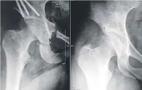  ??  ?? Osteotomía de Ganz por vía mini-invasiva: obsérvese la corrección obtenida de cobertura de la cabeza femoral inmediatam­ente tras la intervenci­ón.