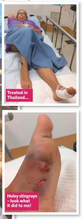  ??  ?? Treated in Thailand… Holey stingrays – look what it did to me!