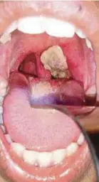  ??  ?? Perbezaan disebabkan tonsil (gambar atas) dan difteria.