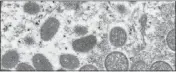  ?? THE ASSOCIATED PRESS ?? This 2003 electron microscope image made available by the Centers for Disease Control and Prevention shows mature, oval-shaped monkeypox virions, left, and spherical immature virions, right, obtained from a sample of human skin associated with the 2003prairi­e dog outbreak.