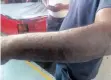  ?? ?? A WORKER whose rash has worsened after pollution around his workplace. | WILLEM PHUNGULA