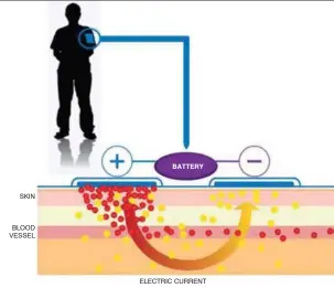  ??  ?? Fig. 1: Typical iontophore­sis operation