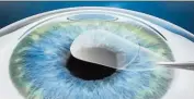  ??  ?? The lenticule is removed through the small incision. The disruption to the biomechani­cs of the cornea is minimal and no flap is cut.