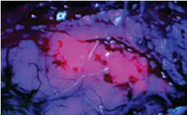  ??  ?? EASY TO SPOT: An area of brain tumour glows due to the Gliolan drink