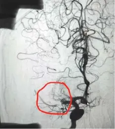  ?? ?? CT scan showing the blocked artery that led to the stroke.