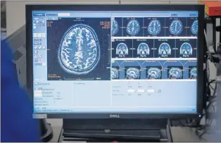  ?? KEVIN VAN PAASSEN/SUNNYBROOK HEALTH SCIENCES CENTRE VIA AP ?? This March 23, 2017 photo shows brain scans of patient Rick Karr as staff members treat him at the facility in Toronto, Canada.