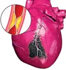  ??  ?? How a clot in the coronary artery causes myocardiac infarction