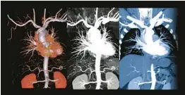  ?? DREAMSTIME ?? Imaging tests of the chest’s thoracic aorta help to diagnose aneurysms.