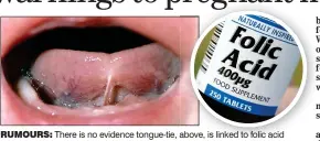  ??  ?? rumours: There is no evidence tongue-tie, above, is linked to folic acid