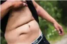  ??  ?? The abdominal scars Gabriel says are from emergency surgery he needed as an infant.