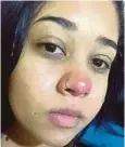  ??  ?? KEADAAN hidung Layane yang bengkak akibat jangkitan kuman selepas bertindik. - Agensi