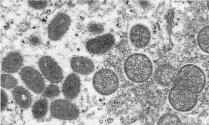  ?? Photograph: AP ?? An electron microscope image showing mature, oval-shaped monkeypox virions (left) and spherical immature virions from a 2003 US outbreak.