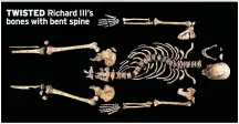  ?? ?? TWISTED Richard III’s bones with bent spine