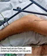  ?? ?? Drew had an ex-fixer, or external fixation, on his arm