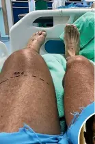  ??  ?? Pete Bethune’s left leg has swollen following a snake bite in Costa Rica.