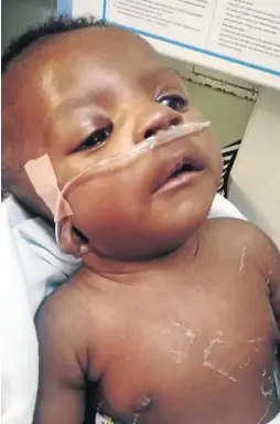  ?? / SUPPLIED ?? Four-month-old Nathaniel Zengwe was born with a rare congenital defect called Goldenhar Syndrome.