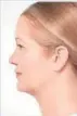  ??  ?? El coolsculpt­ing remodela el óvalo facial sin pasar por el quirófano aplicando frío sobre la grasa acumulada en el cuello