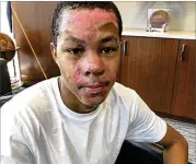  ?? AP ?? Malachi McFadden is left with burns on his face, neck and arms after fire landed on him during a chemistry class experiment on the second day of classes at Redan High.