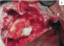  ??  ?? 8 Fig. 7: Radiografí­a panorámica preoperato­ria. Fig. 8: Colgajo mucoperiós­tico a espesor total e identifica­ción del canino incluido superior derecho. Fig. 9: Imagen intraopera­toria de la colocación del retractor cigomático. Obsérvese la dirección de la osteotomía hacia el retractor. Fig 10: Trayectori­a del implante posterior del lado derecho respetando los puntos de entrada del proceso alveolar y a través de la cortical inferior del hueso cigomático.