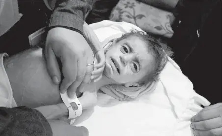  ??  ?? A severely malnourish­ed child at the al-Kahef hospital in Kafr Batna, Eastern Ghouta, near Damascus, Syria.